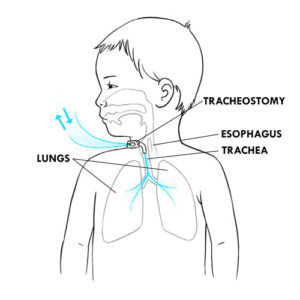 Tracheostomy Care